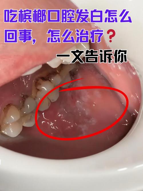 口腔溃疡能不能吃槟榔