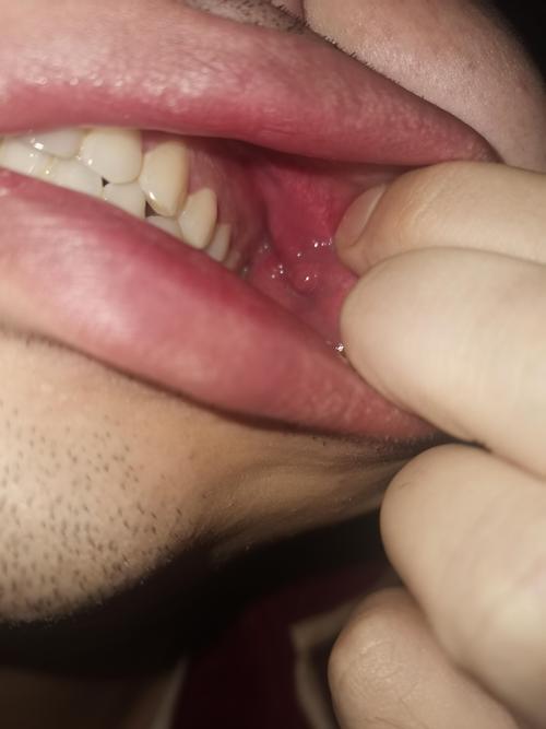 漱口水用后口腔黏膜脱落,是正常反应吗?