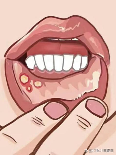 唇内侧口腔溃疡如何快速止痛?