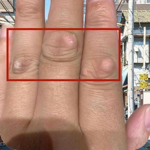 手指皮肤变硬怎么回事