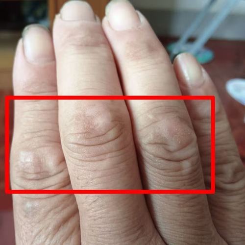 手指皮肤变硬怎么回事