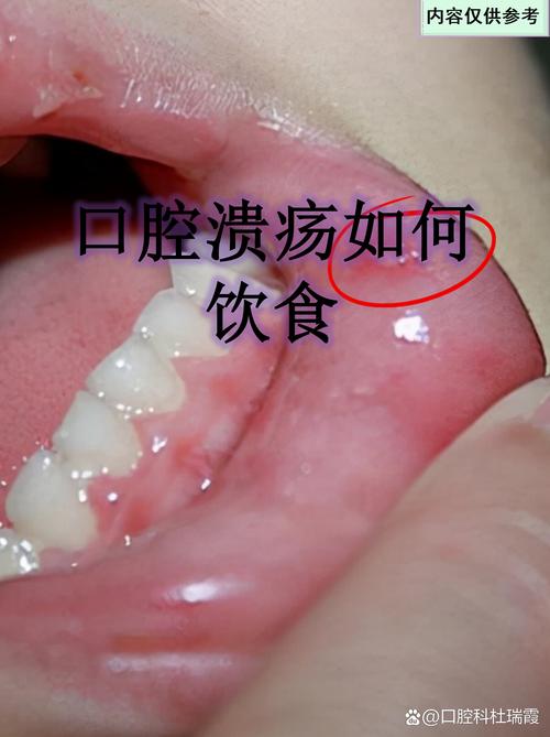口腔溃疡能吃菠萝吗?