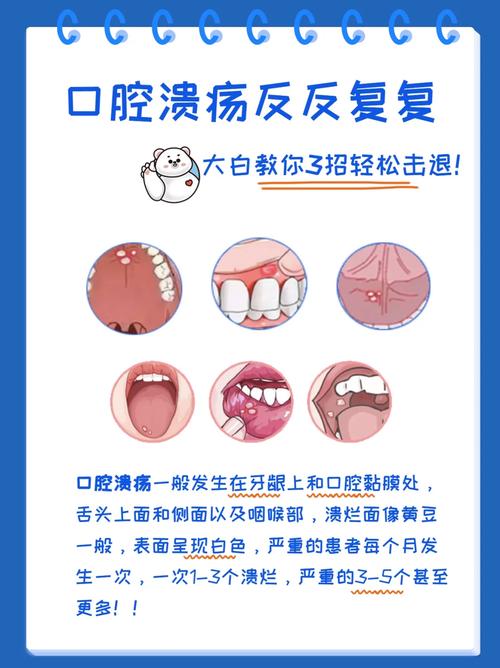 孕妇口腔溃疡怎么办?