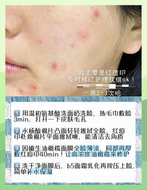 精油灼伤皮肤多久消退