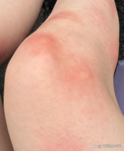 运动皮肤发痒什么回事