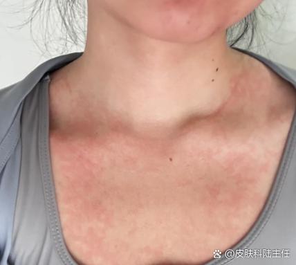 运动皮肤发痒什么回事