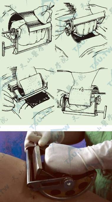 皮肤移植一厘米费用受哪些因素影响?