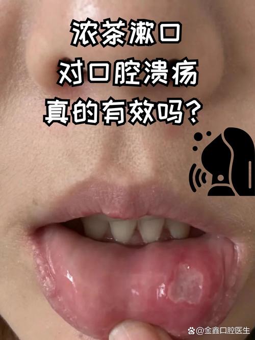 口腔溃疡喝牛奶有用吗