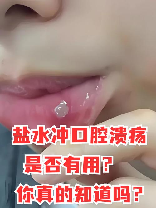 口腔溃疡喝牛奶有用吗