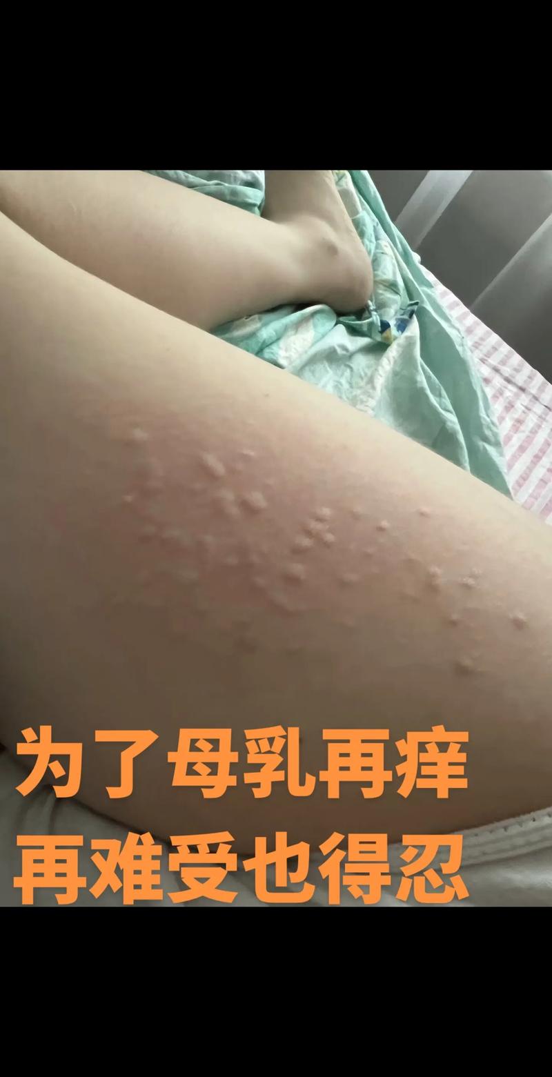 产后皮肤痒,怎么办?