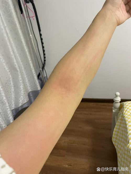 产后皮肤痒,怎么办?