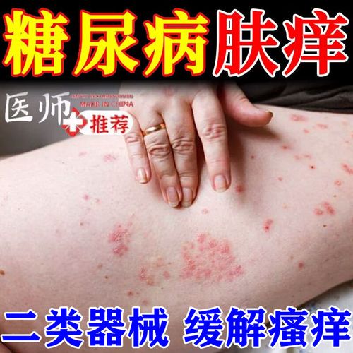 血糖高会引起皮肤痒吗