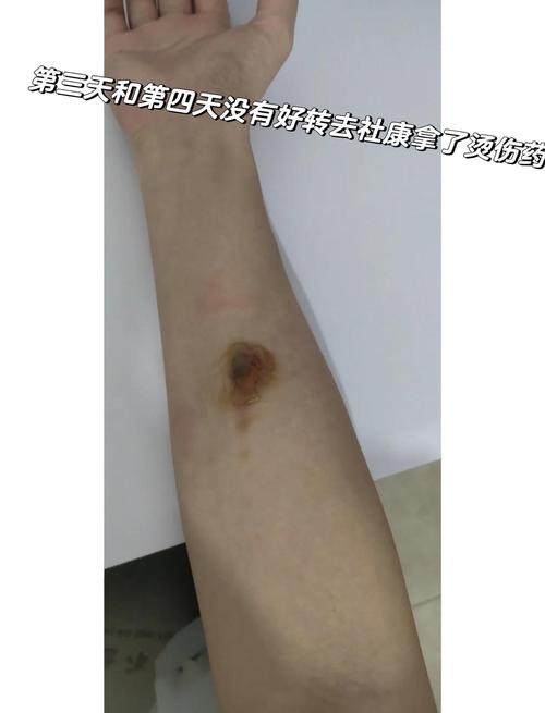 皮肤火辣辣烧灼怎么治