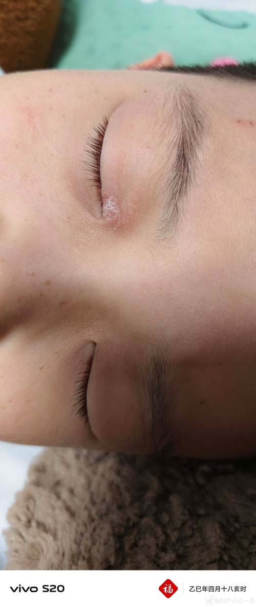 金霉素眼膏能治皮肤过敏吗?