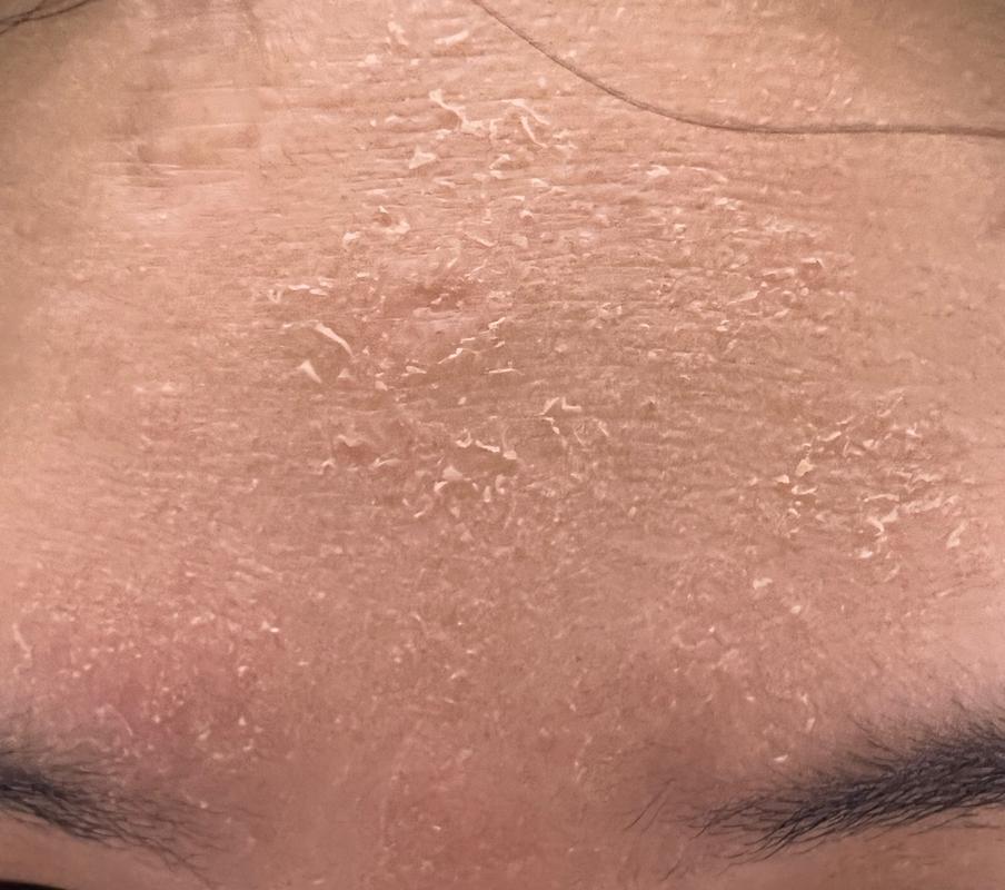 脸上皮肤起皮发红干痛