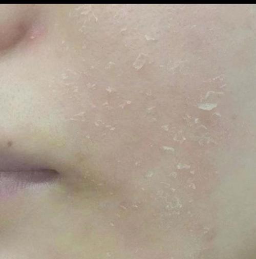 脸上皮肤起皮发红干痛