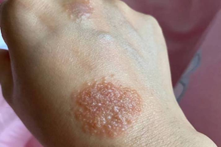 皮肤起水泡溃烂流黄水是何原因?