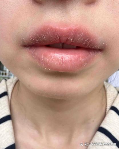 嘴巴一破皮为何总成口腔溃疡?