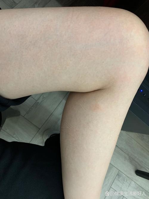 喝酒皮肤过敏症状图片有哪些表现?