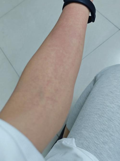 喝酒皮肤过敏症状图片有哪些表现?