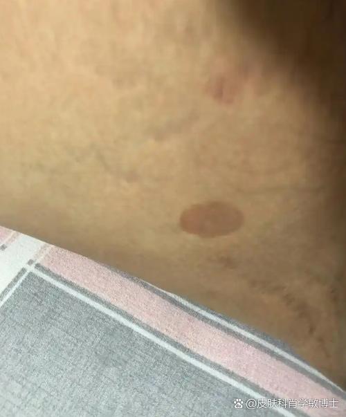 皮肤颜色变深是身体发出的什么信号?