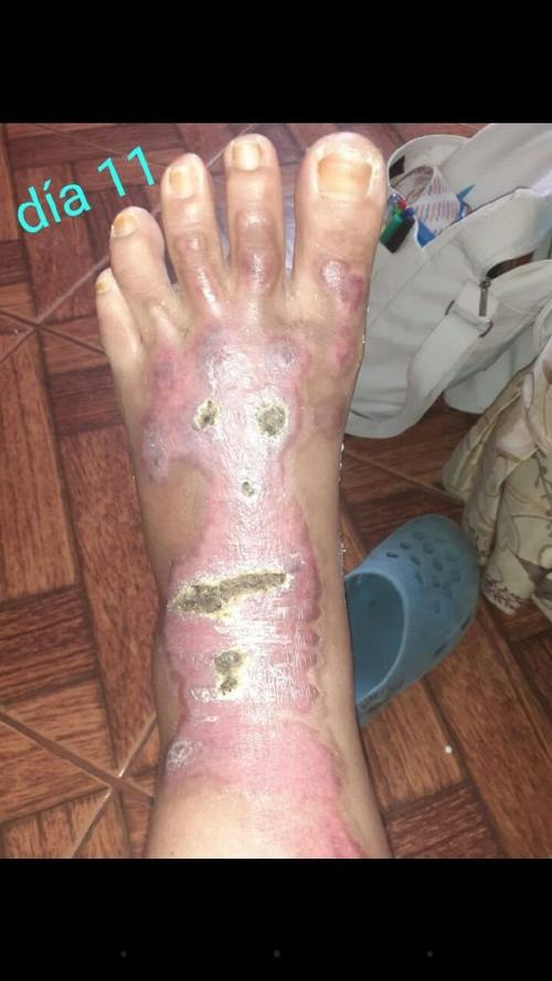 被盐酸腐蚀后皮肤图片