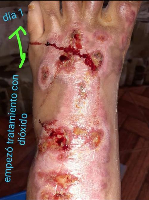 被盐酸腐蚀后皮肤图片