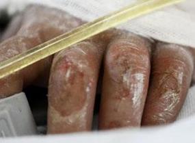 被盐酸腐蚀后皮肤图片