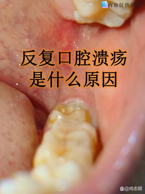 口腔溃疡反复是缺锌导致的吗?