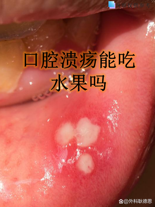 口腔溃疡能吃小龙虾吗?