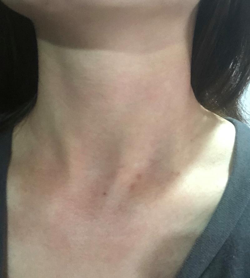脖子皮肤过敏症状图片有哪些表现?