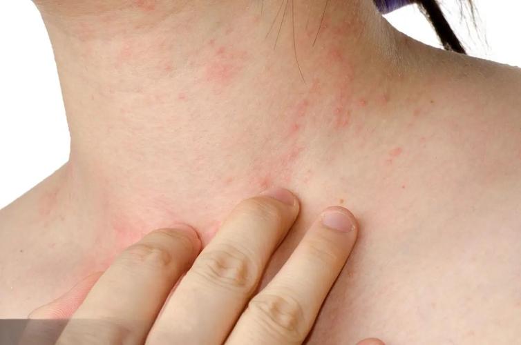 脖子皮肤过敏症状图片有哪些表现?