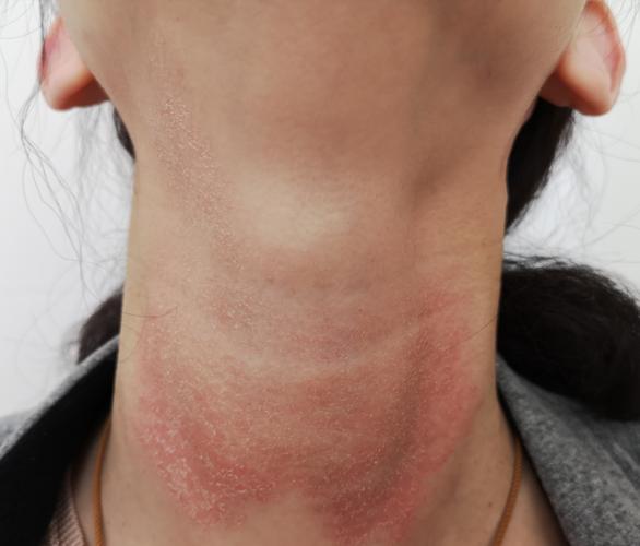 脖子皮肤过敏症状图片有哪些表现?