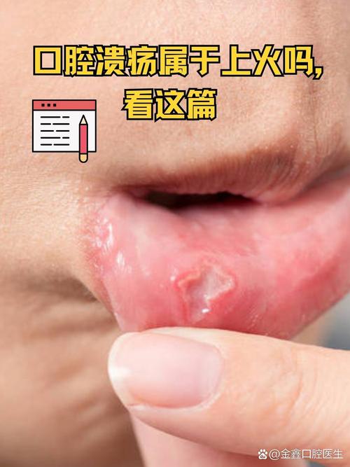经常口腔溃疡是缺锌吗
