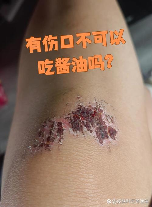 酱油吃多了皮肤会变黑吗?