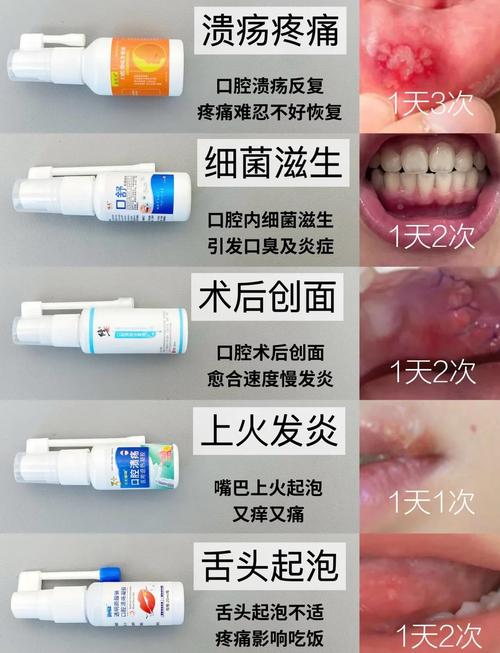 口腔溃疡严重如何快速缓解?