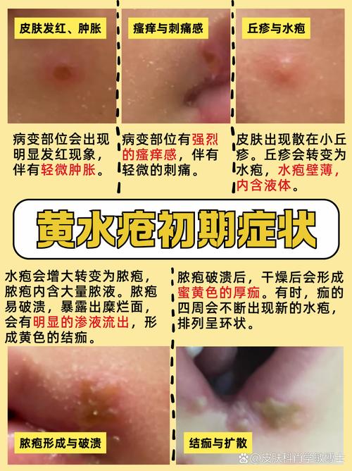 皮肤脓包是感染还是其他问题?