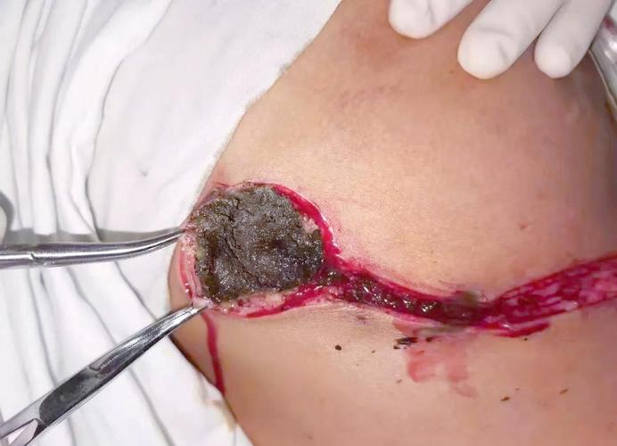 被水泥弄伤皮肤怎么办