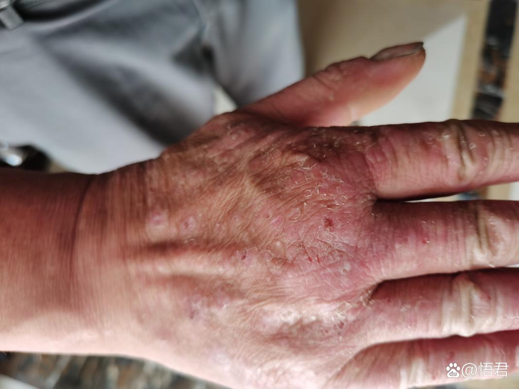 被水泥弄伤皮肤怎么办