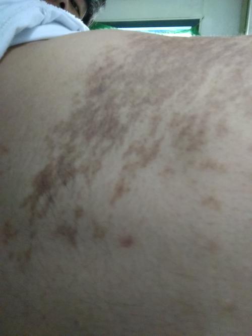 皮肤痒过之后变黑图片