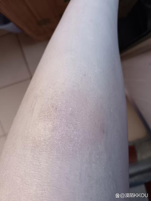 皮肤痒过之后变黑图片