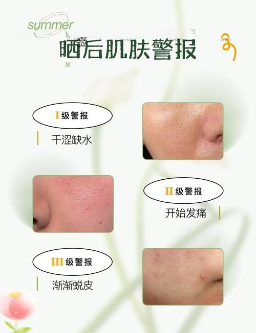 日光性皮肤炎怎么治?日常防护与用药要点?