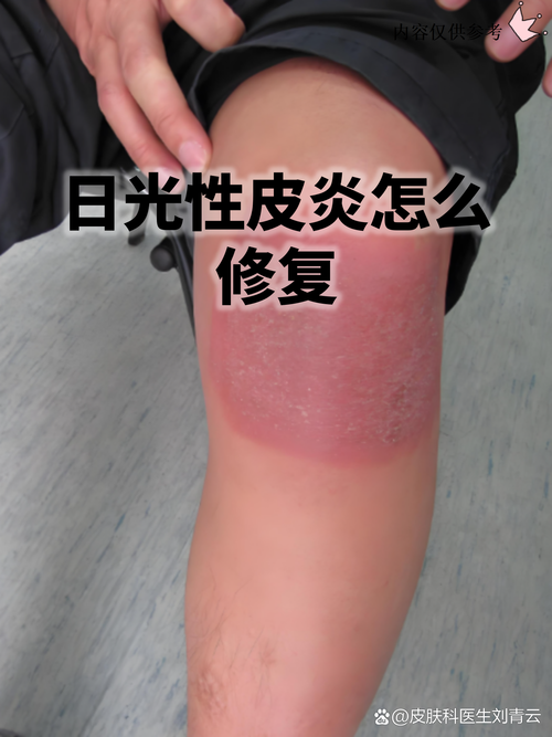 日光性皮肤炎怎么治?日常防护与用药要点?