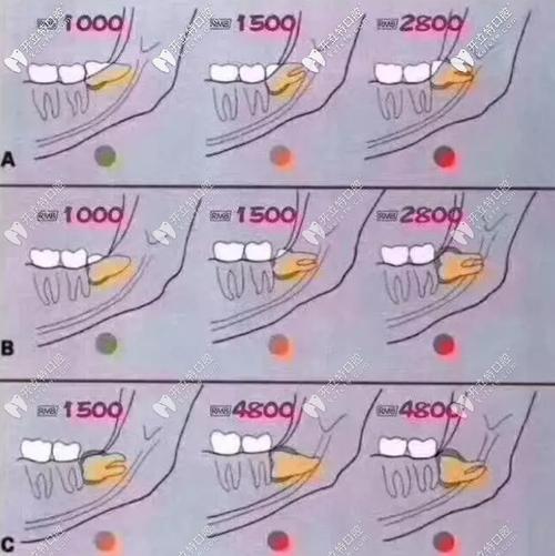 拜博口腔拔智齿多少钱一颗?