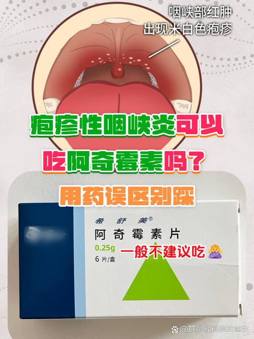 阿奇霉素能治口腔溃疡吗?
