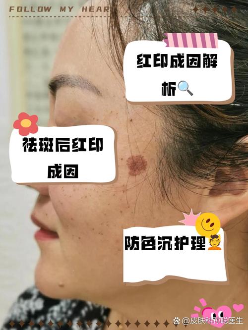 激光祛斑痂掉了皮肤红