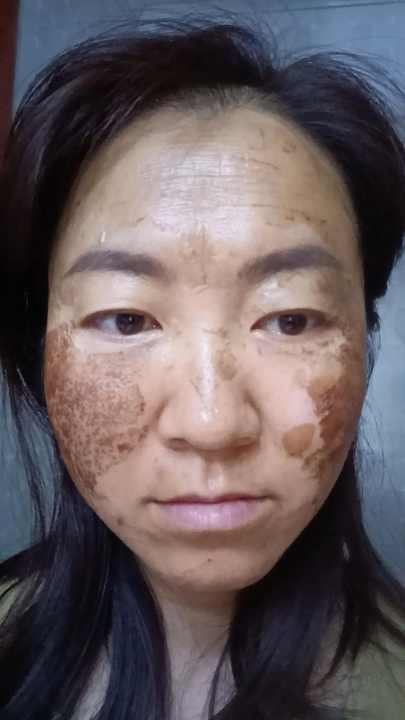 激光祛斑痂掉了皮肤红