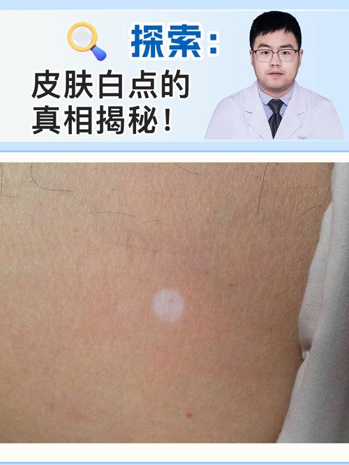 皮肤白点病是怎么回事