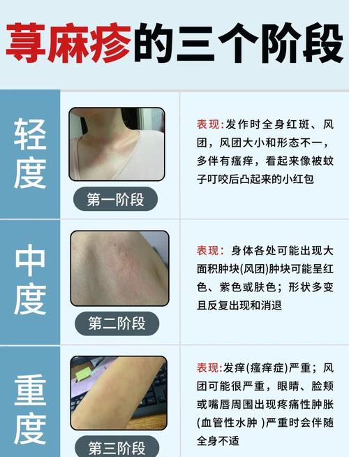 皮肤过敏不治能自己好?