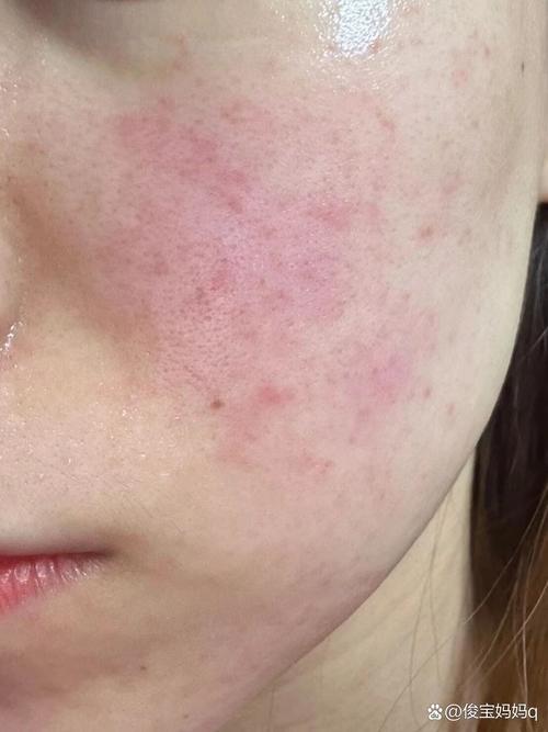 皮肤过敏不治能自己好?